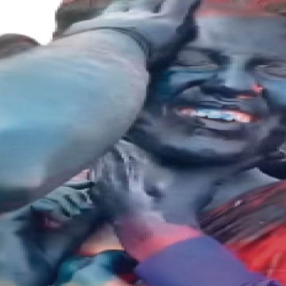 स्क्रीन ने बढ़ाया मर्ज:रील के नुस्खे स्किन पर पड़े भारी; होली के बाद उल्टे सीधे नुस्खों के कारण जलन, इन्फेक्शन, स्थायी निशान हो गए